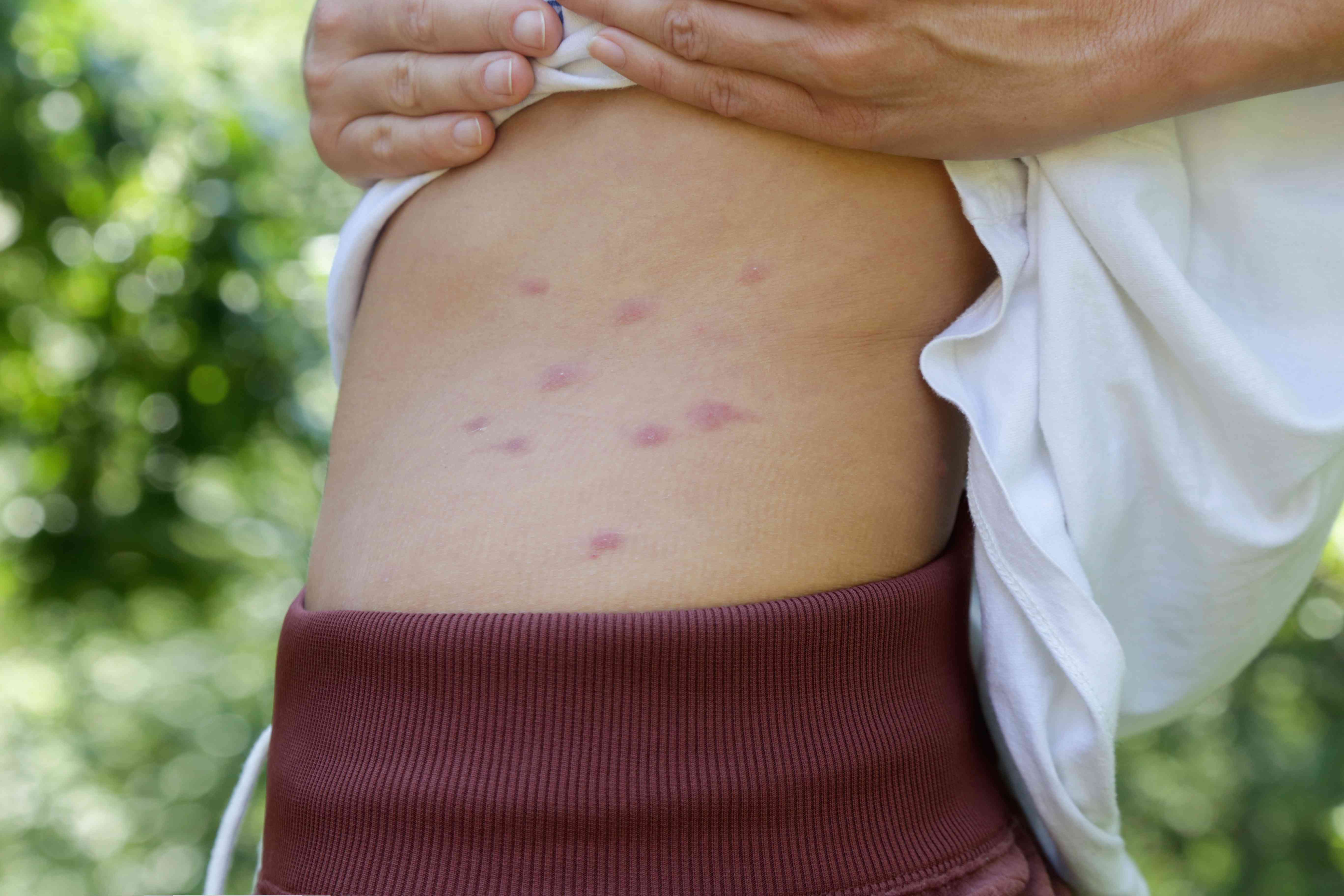 Best Homeopathic Solutions for Bug Bites: Soothe Itching and Reduce Swelling