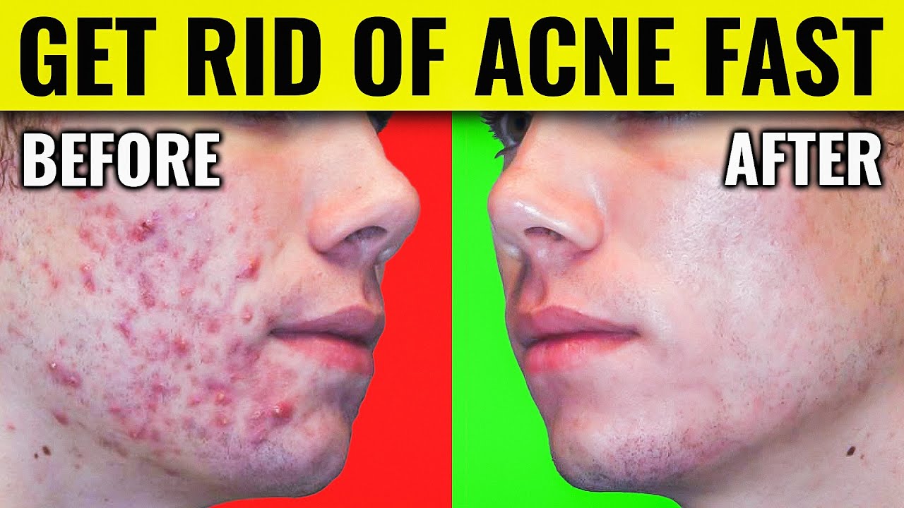 Say goodbye to acne op rug: Simple tips for clear skin