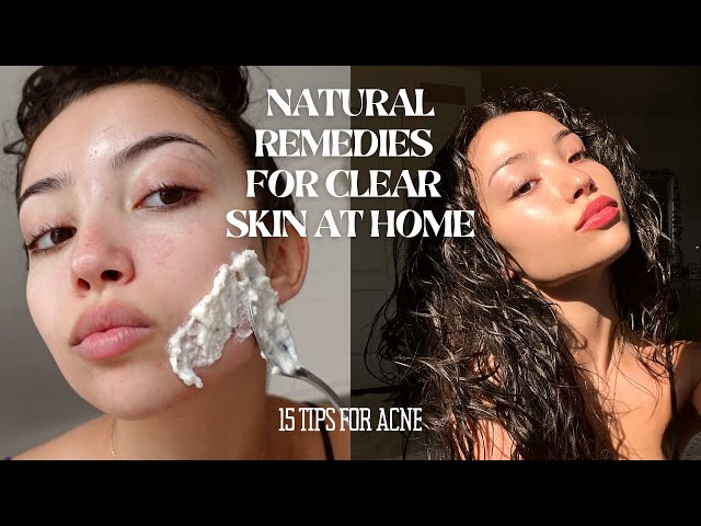 Acnee Free: Your Guide to a Clear and Beautiful Complexion